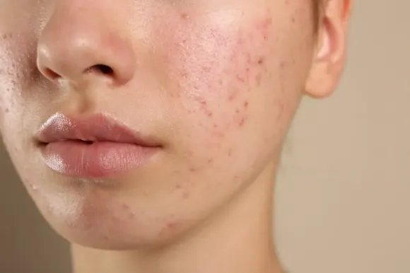 10 Sai Lầm Khiến Nám Nặng Hơn Và Khó Điều Trị Dứt Điểm